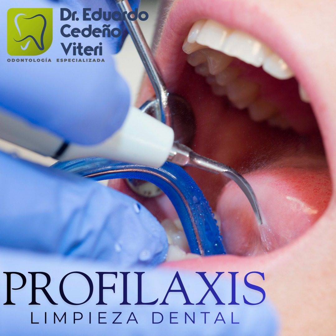 Limpieza Dental Profunda y Desmanchado. Descuentos y Beneficios, según formas de pago