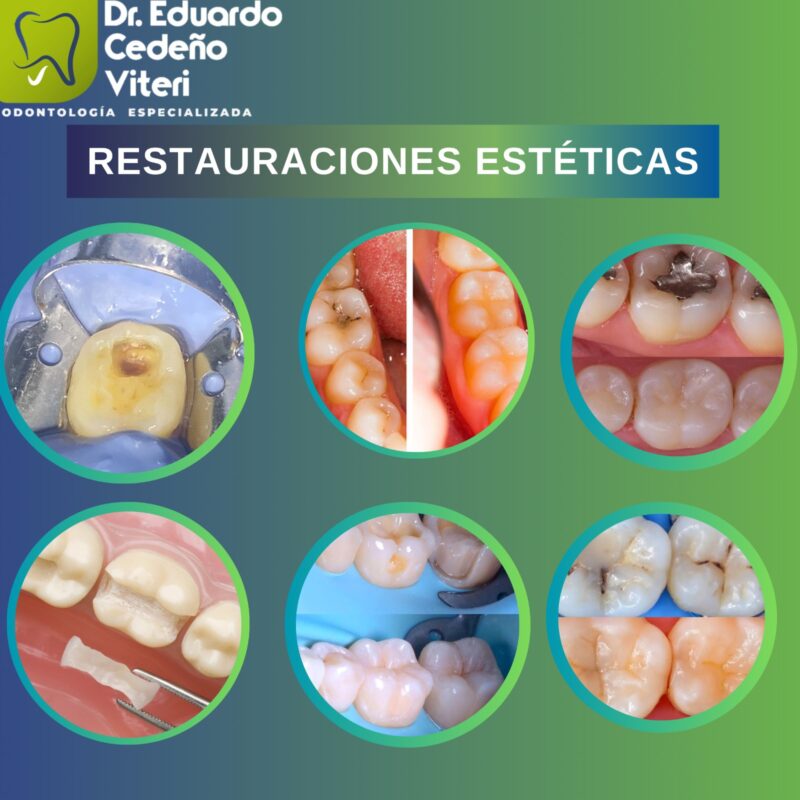 CALCES ESTÉTICOS
