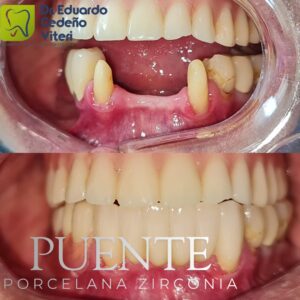 Soluciones dentales fijas