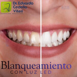 Sonrisa Blanca y radiante