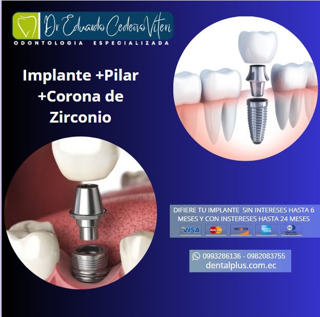 "Implantes Dentales: Recupera tu Sonrisa y Confianza" - Imagen 2