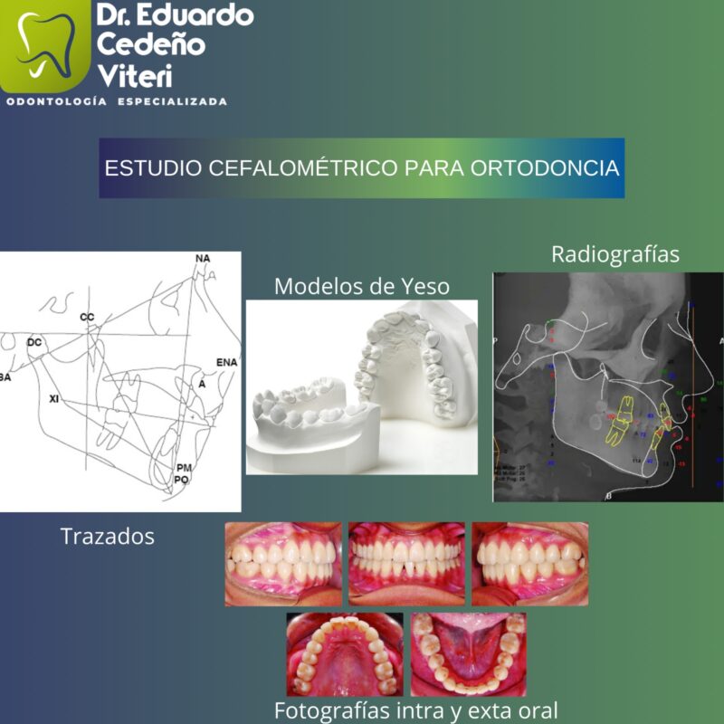 Análisis Cefalométrico para Ortodoncia