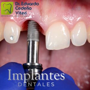 "Implantes Dentales: Recupera tu Sonrisa y Confianza"
