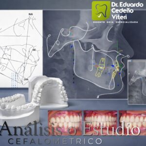 Análisis Cefalométrico antes de la Ortodoncia