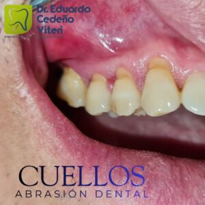 Sensibilidad y Encías Retraídas: Soluciones definitivas para tu sonrisa