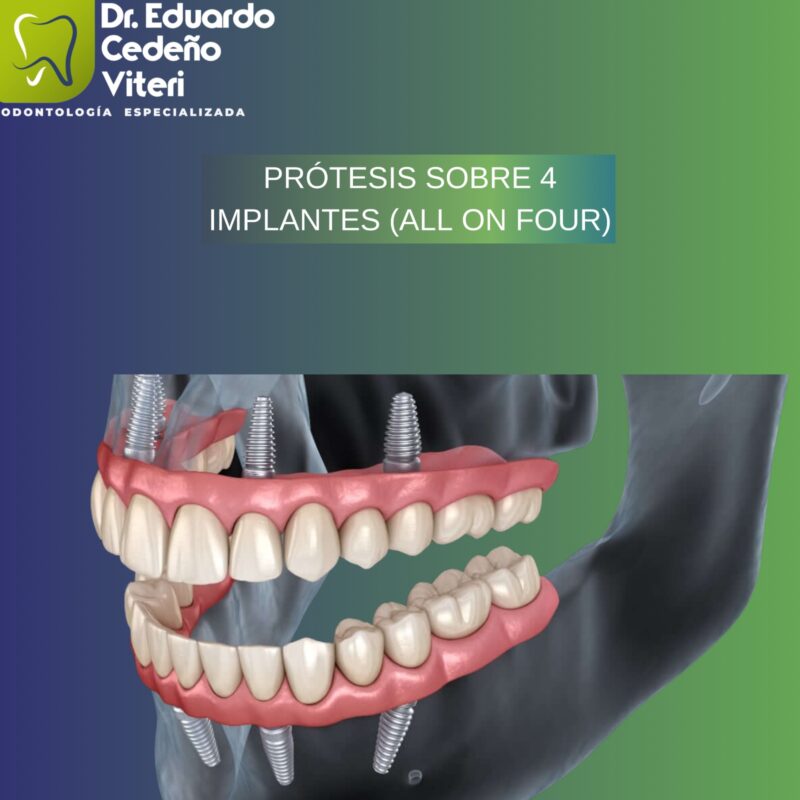 Prótesis sobre Implantes