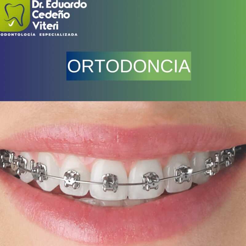 Ortodoncia con Brackets Convencionales y Autoligados