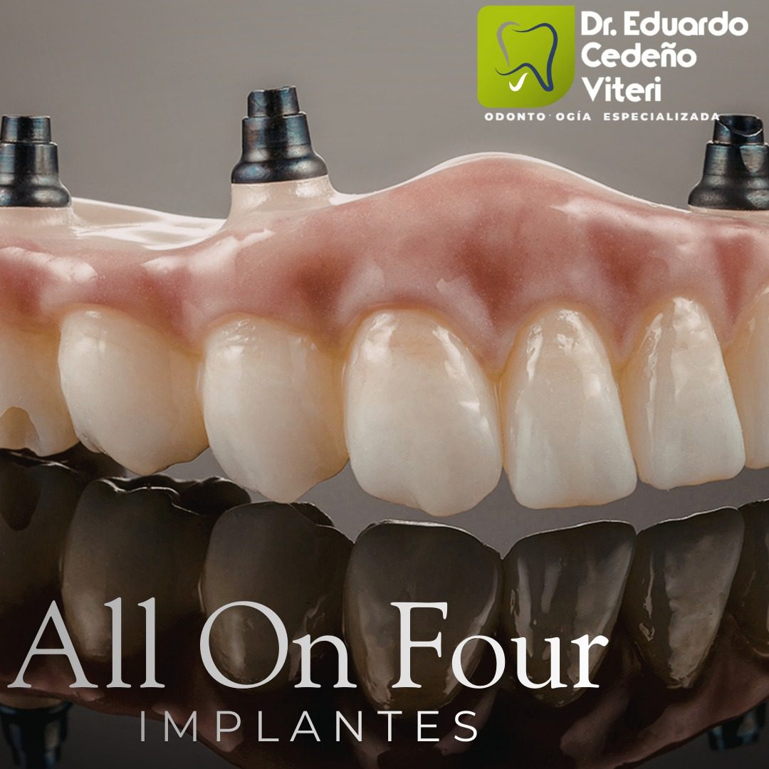 Prótesis sobre 4 implantes