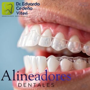 Alinea tu sonrisa sin brackets